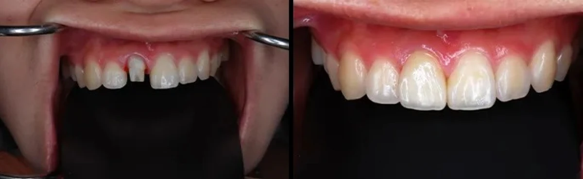 セカンドカウンセリング