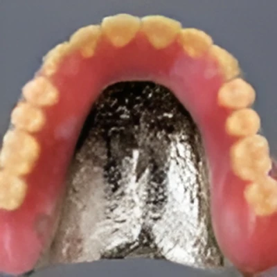 コバルトクロム床