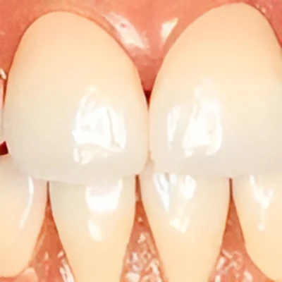 ジルコニアボンド