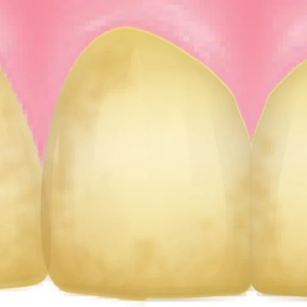 歯が白くなるメカニズム